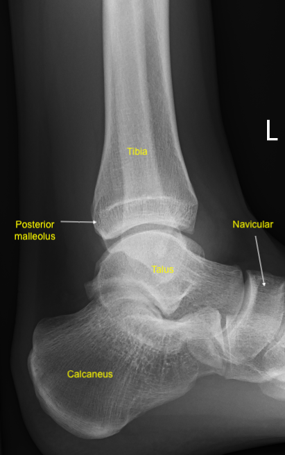 Ankle Fractures | Treatment & Management | Point Of Care