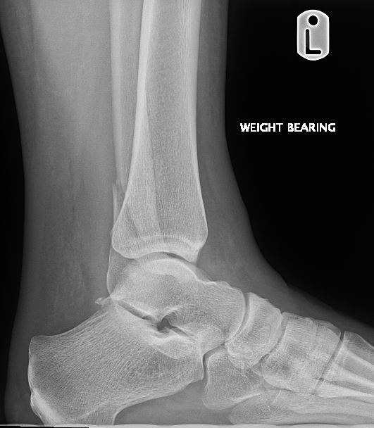 Ankle Fractures | Treatment & Management | Point Of Care