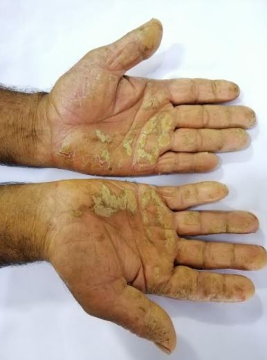 Palmoplantar Psoriasis | Treatment & Management | Point of Care