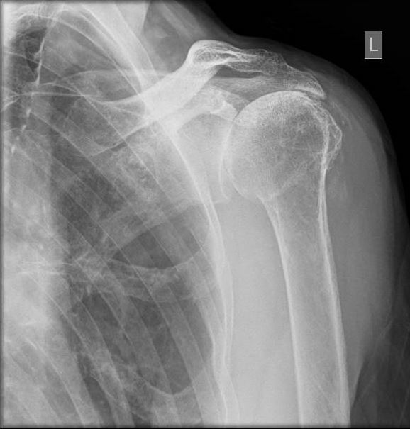 Reversed Shoulder Arthroplasty Article