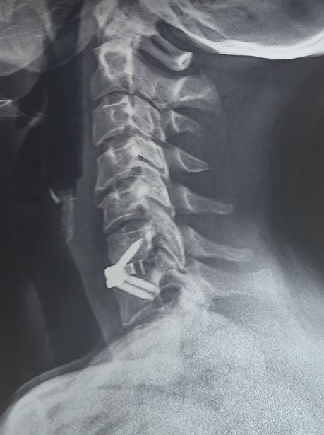 Cervical Disc Herniation Article