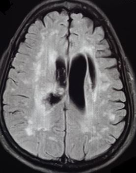 White Matter Lesions Article