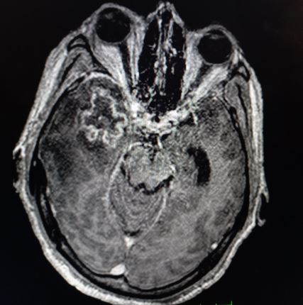 Glioblastoma Multiforme | Treatment & Management | Point of Care