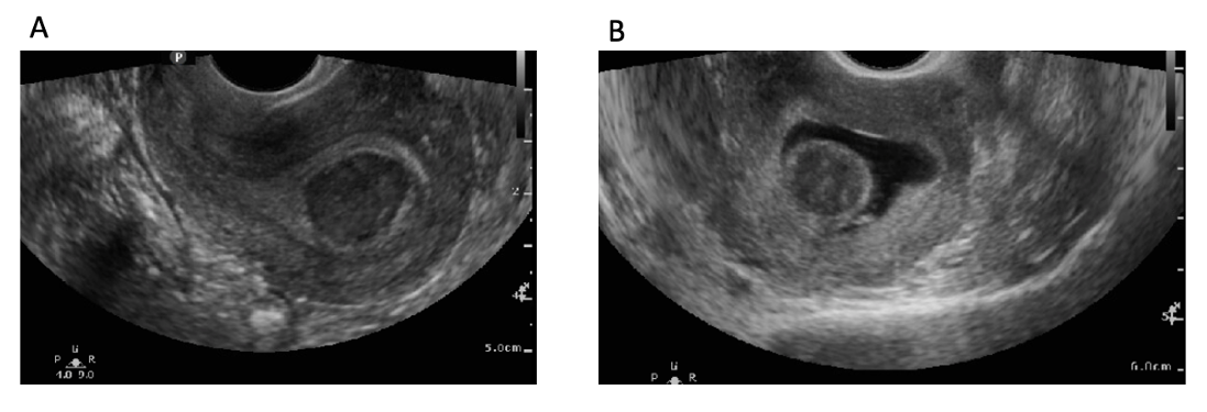 Sonography Female Pelvic Pathology Assessment, Protocols, And ...