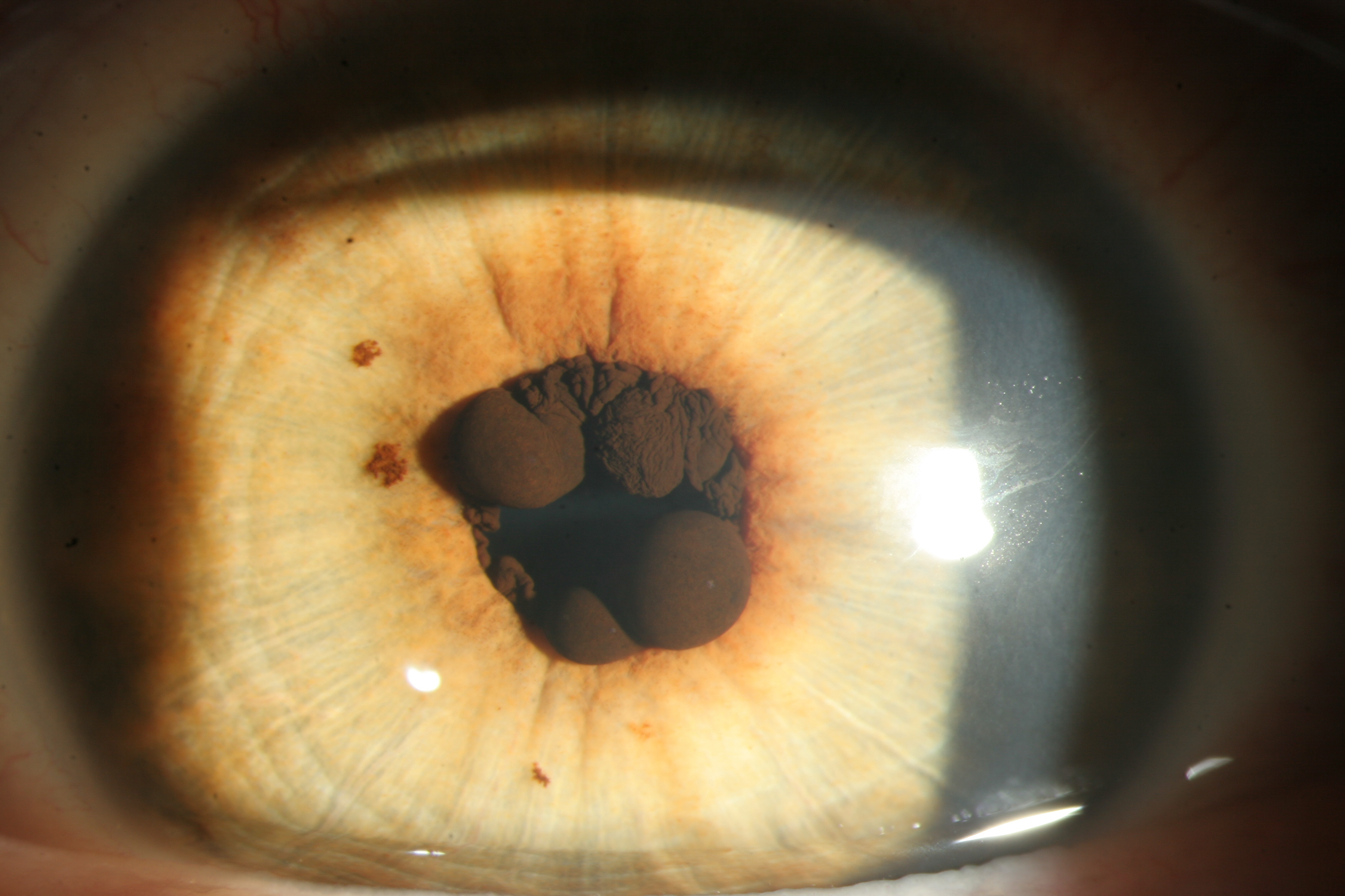 Iris Cyst