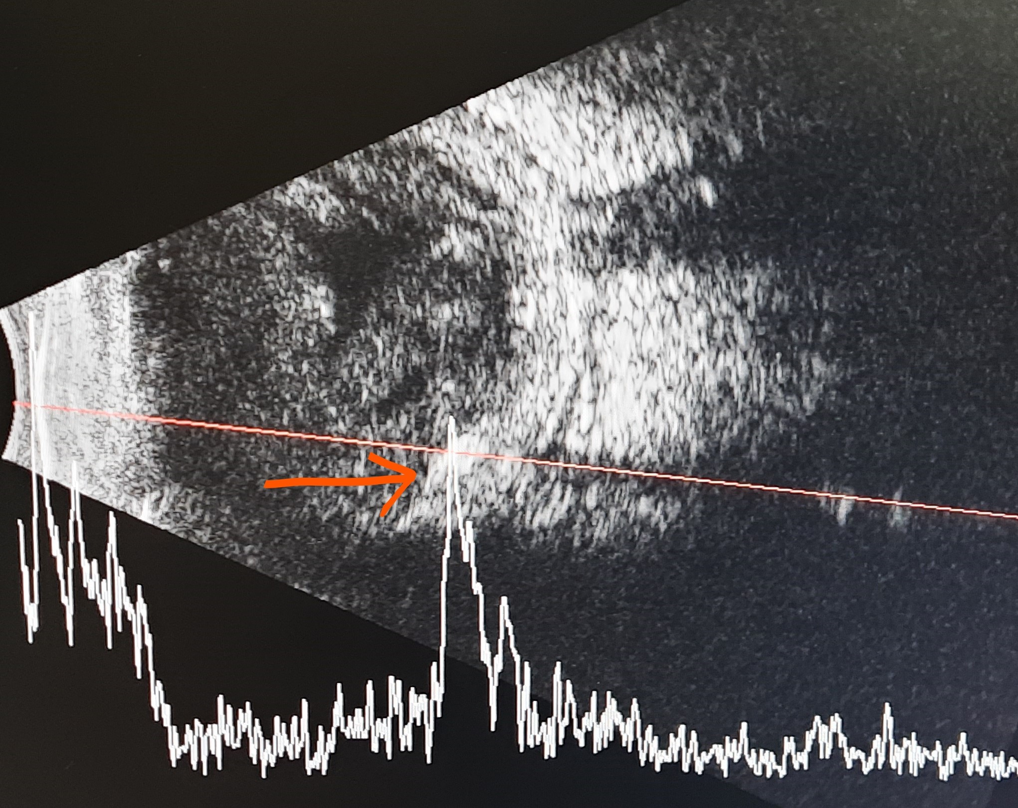 Intraocular Foreign Body Article