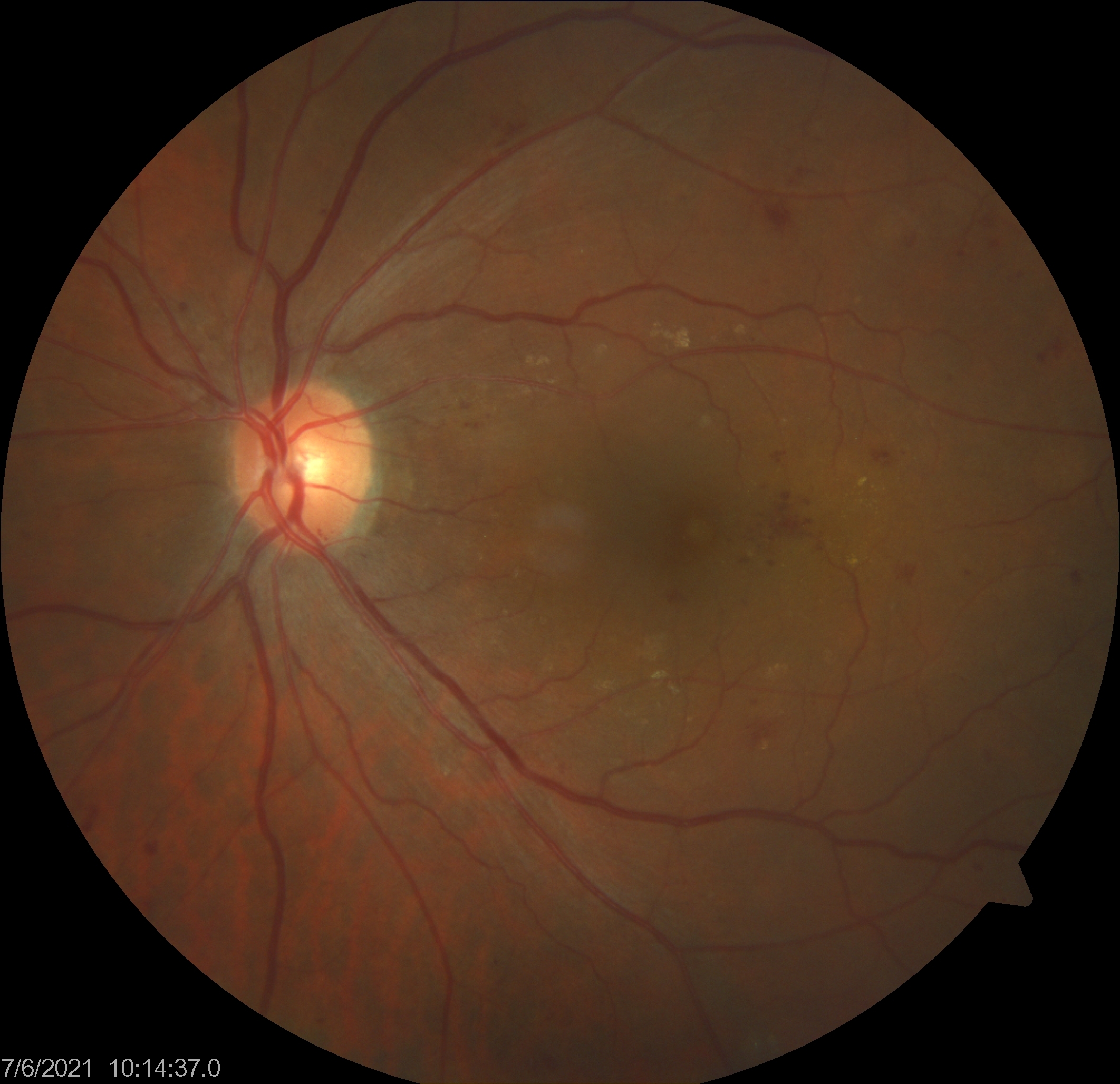 Macular Edema Article