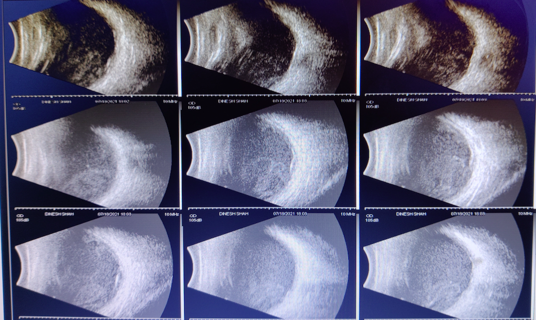 Endogenous Endophthalmitis Article