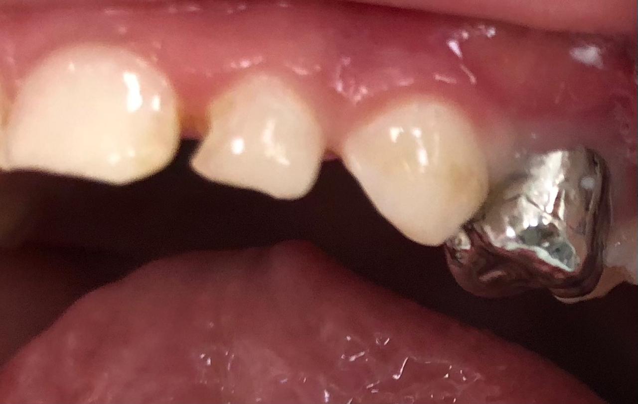 Stainless Steel Crowns In Primary Dentition Article