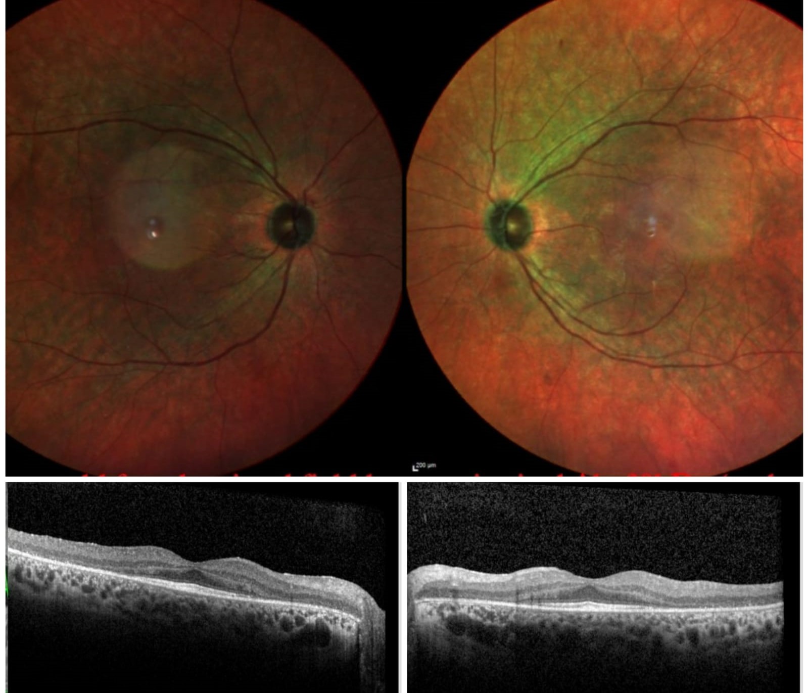 Cancer-Associated Retinopathy | Treatment & Management | Point Of Care