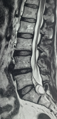 Tarlov Cyst Article