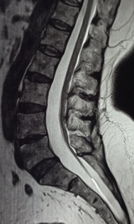 Tethered Cord Syndrome (TCS) | Treatment & Management | Point of Care