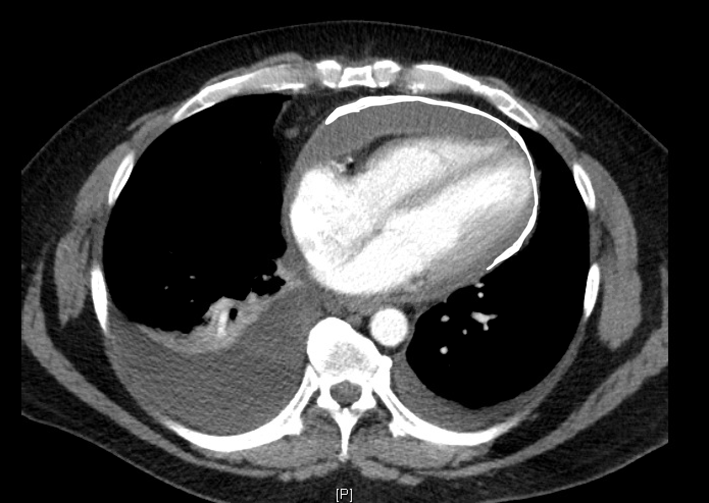 Pericardial Calcification Article