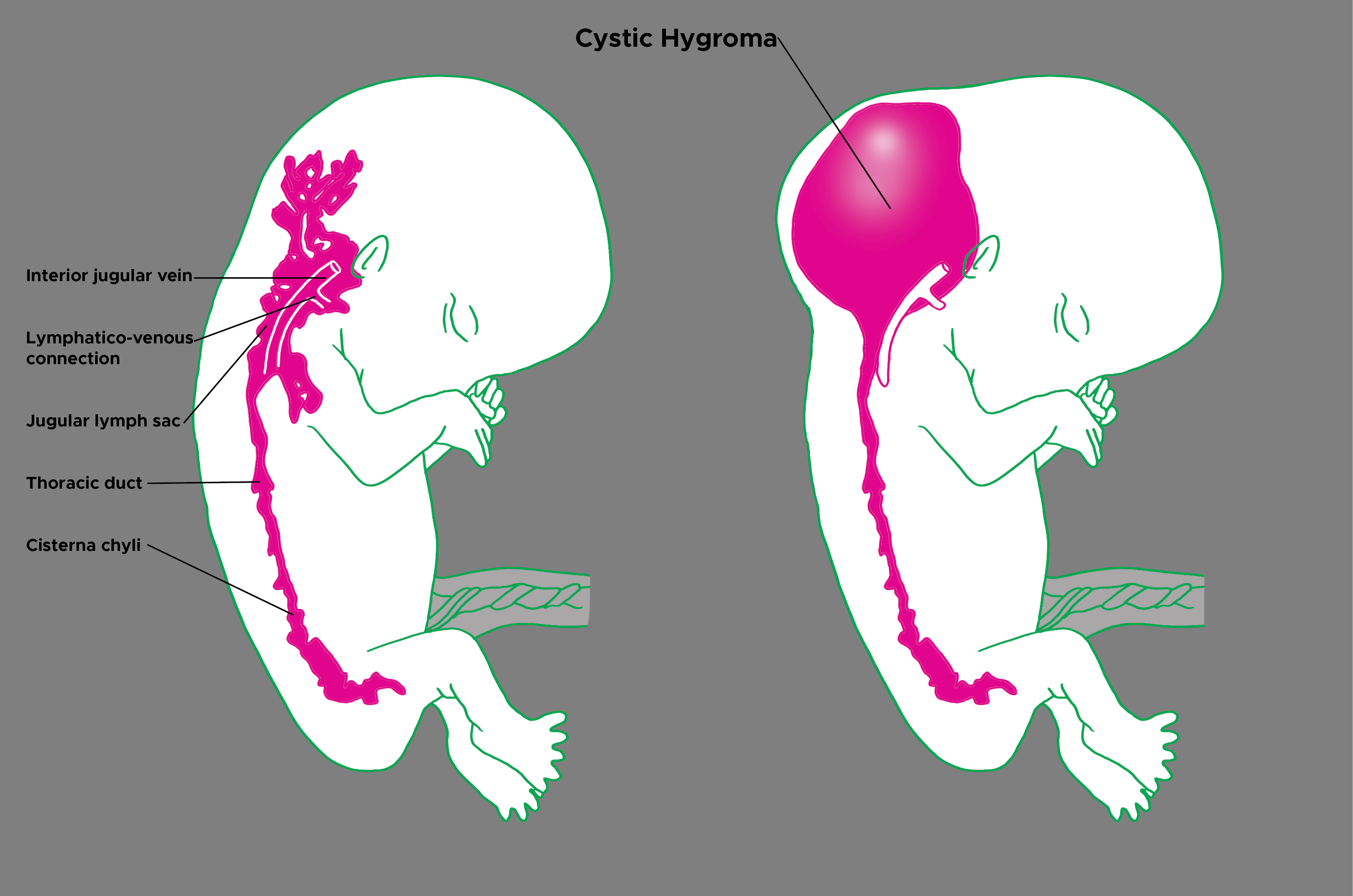 Cystic Hygroma