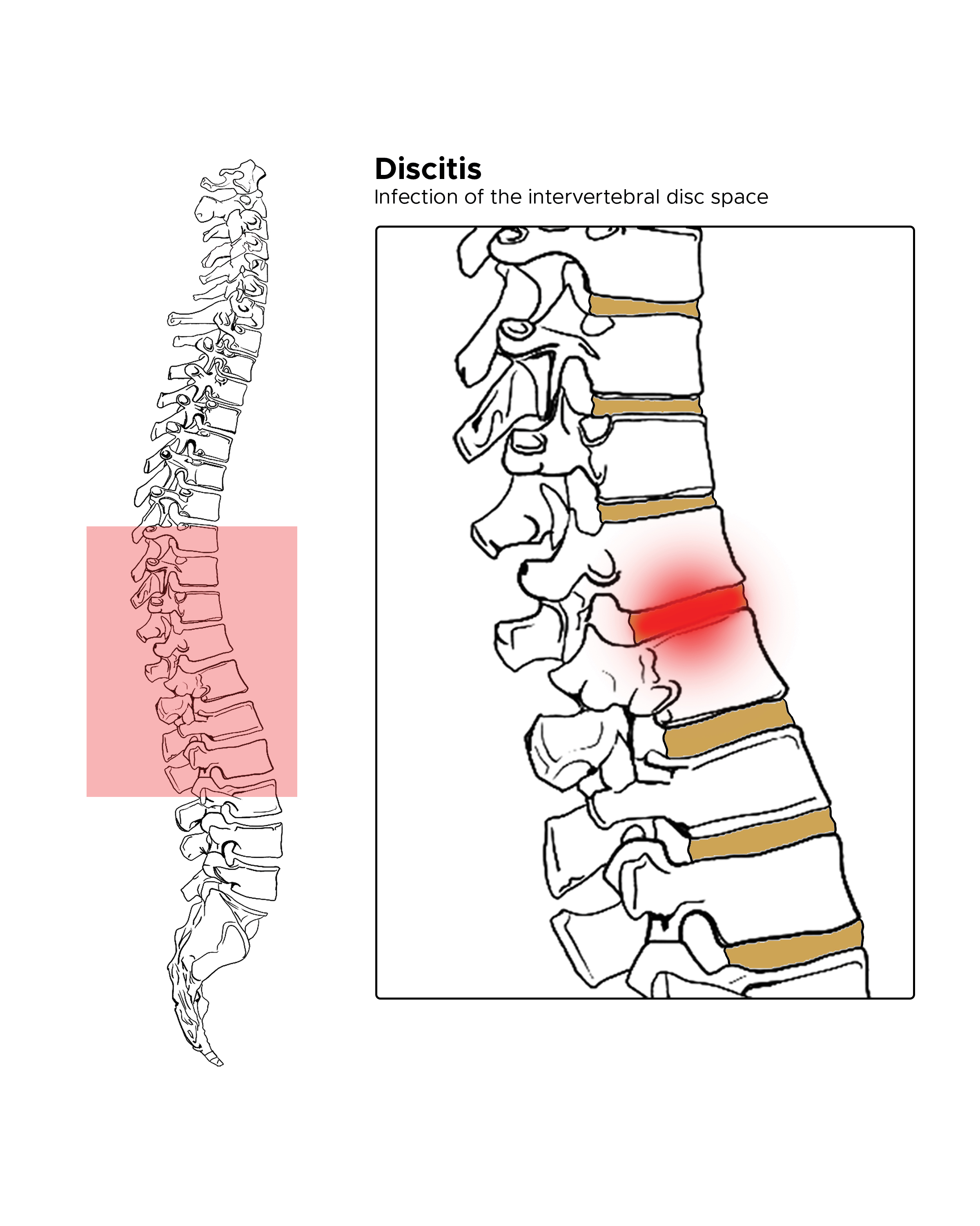 Diskitis Article