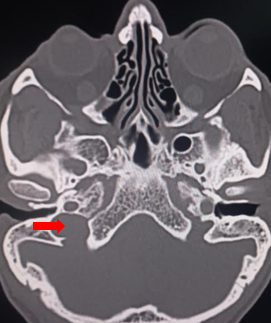 Anatomy, Head and Neck: Jugular Foramen Article