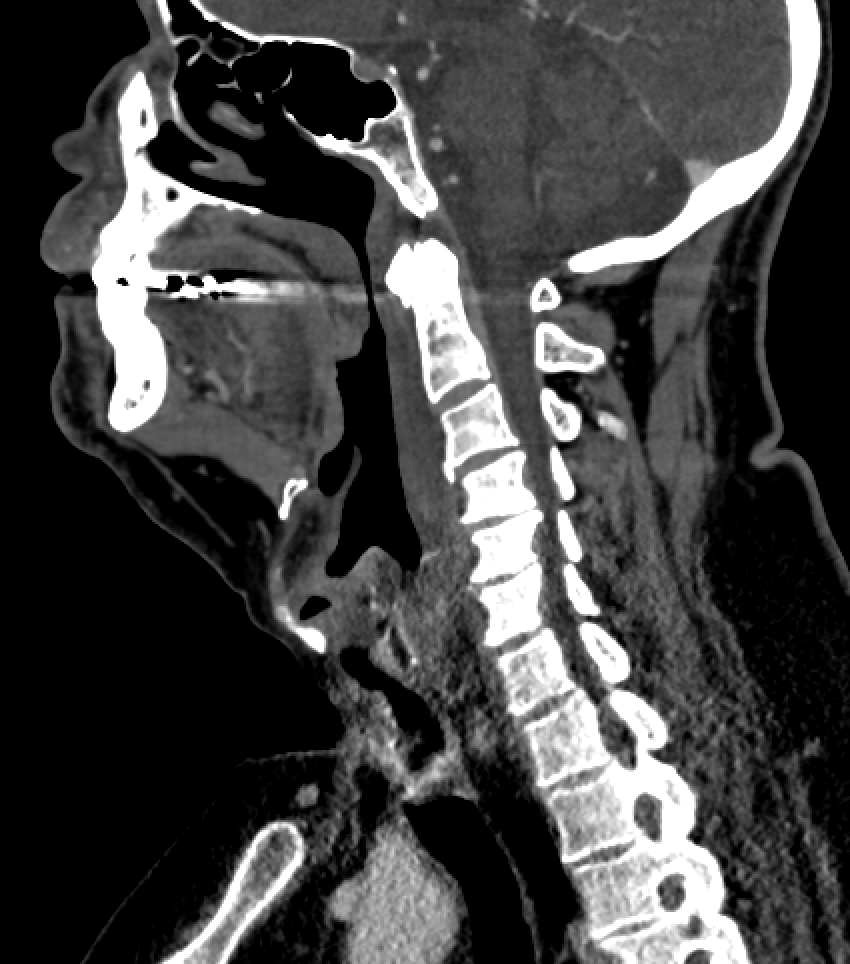 Retropharyngeal Abscess | Treatment & Management | Point of Care