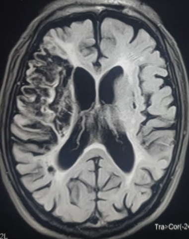 Ischemic Stroke | Treatment & Management | Point of Care