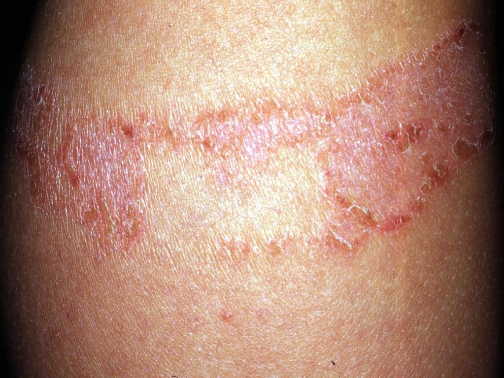 Allergic Contact Dermatitis Article