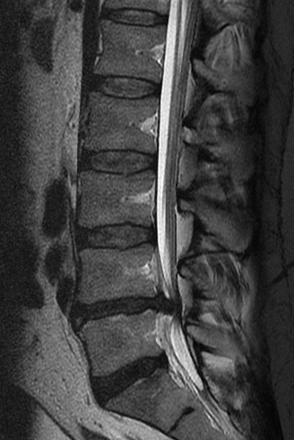 Anatomy, Back, Spinal Nerve-Muscle Innervation | Treatment & Management ...