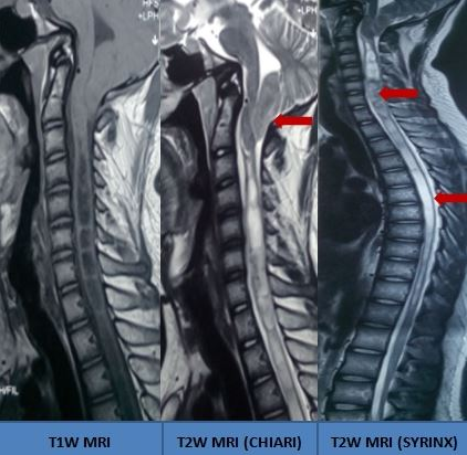 Syringomyelia | Treatment & Management | Point of Care