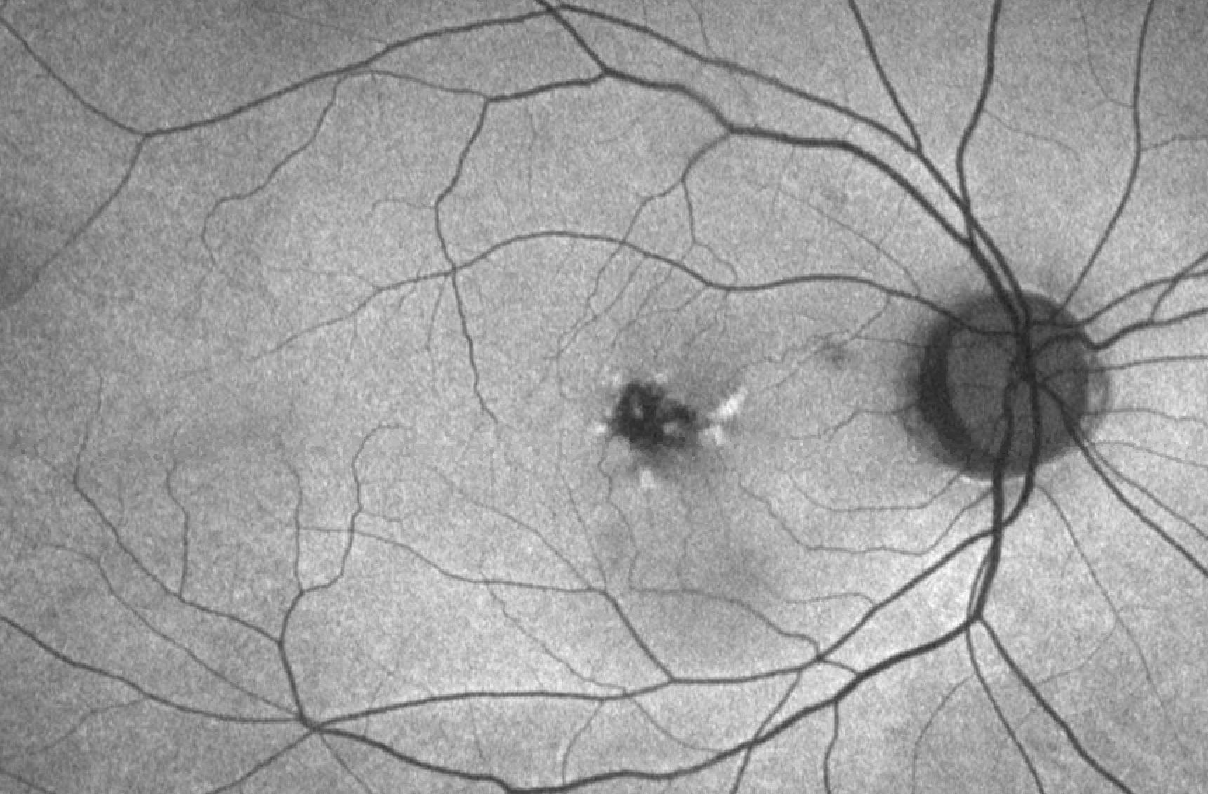 Retinal Pattern Dystrophy Article