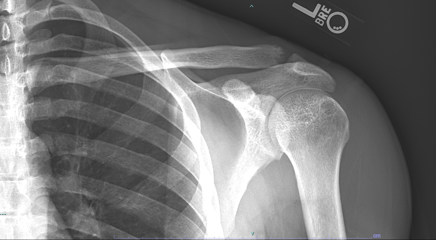 Distal Clavicular Osteolysis Article