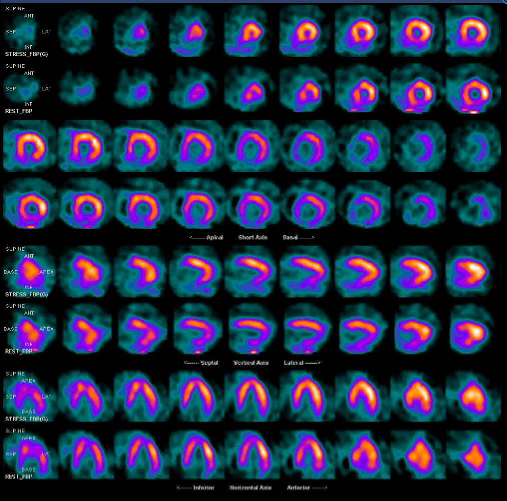 Radiation-Induced Coronary Artery Disease Article