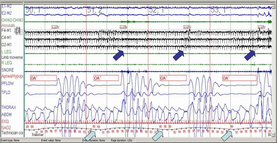 Obstructive Sleep Apnea Article