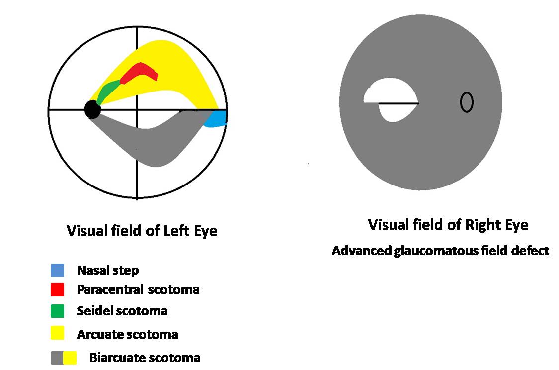 Which Is And Nasal Visual Field Interpretation