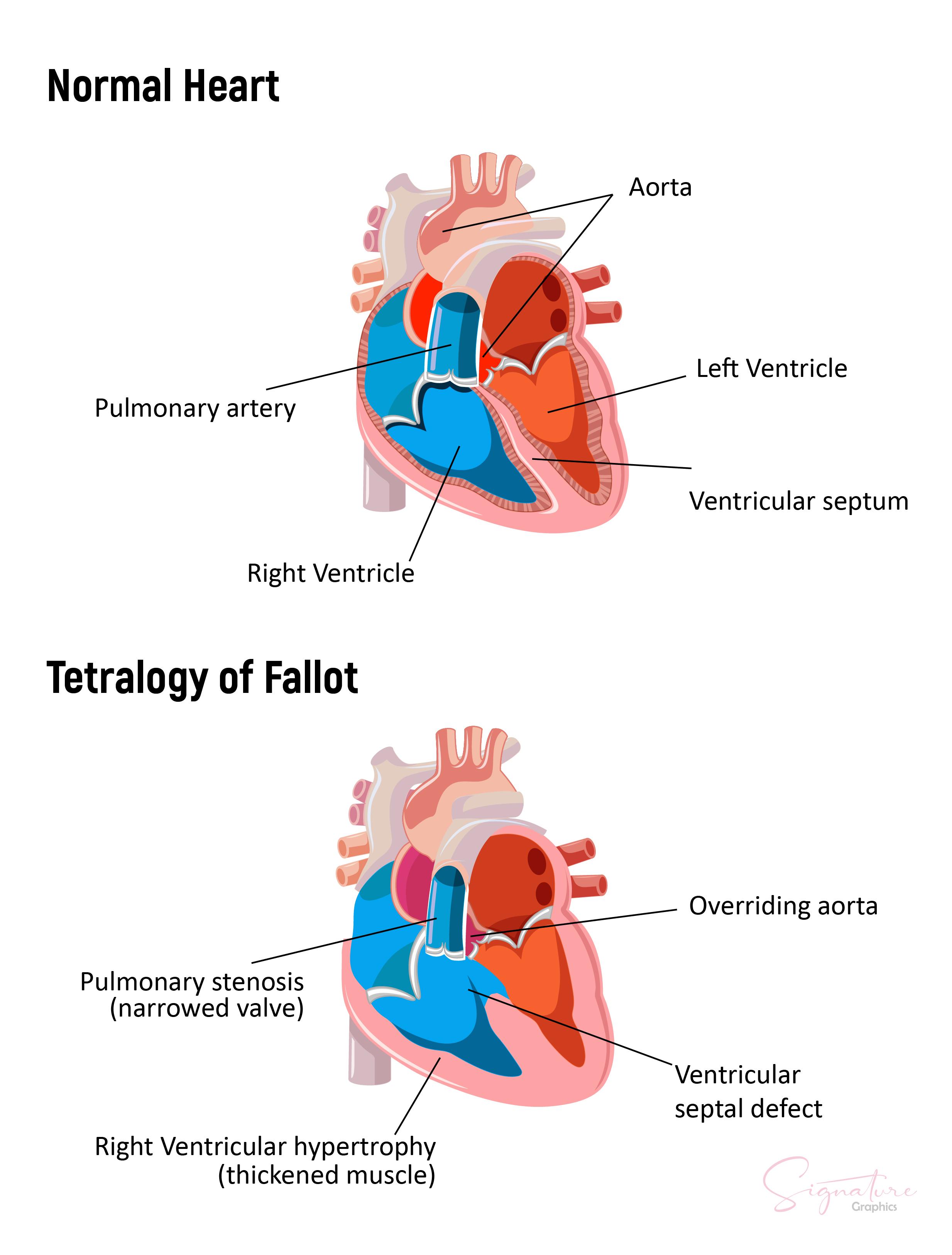 perioperative-management-of-patients-with-congenital-heart-disease-article