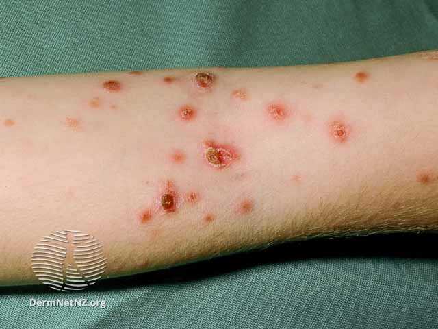 Pityriasis Lichenoides Et Varioliformis Acuta (PLEVA) Article