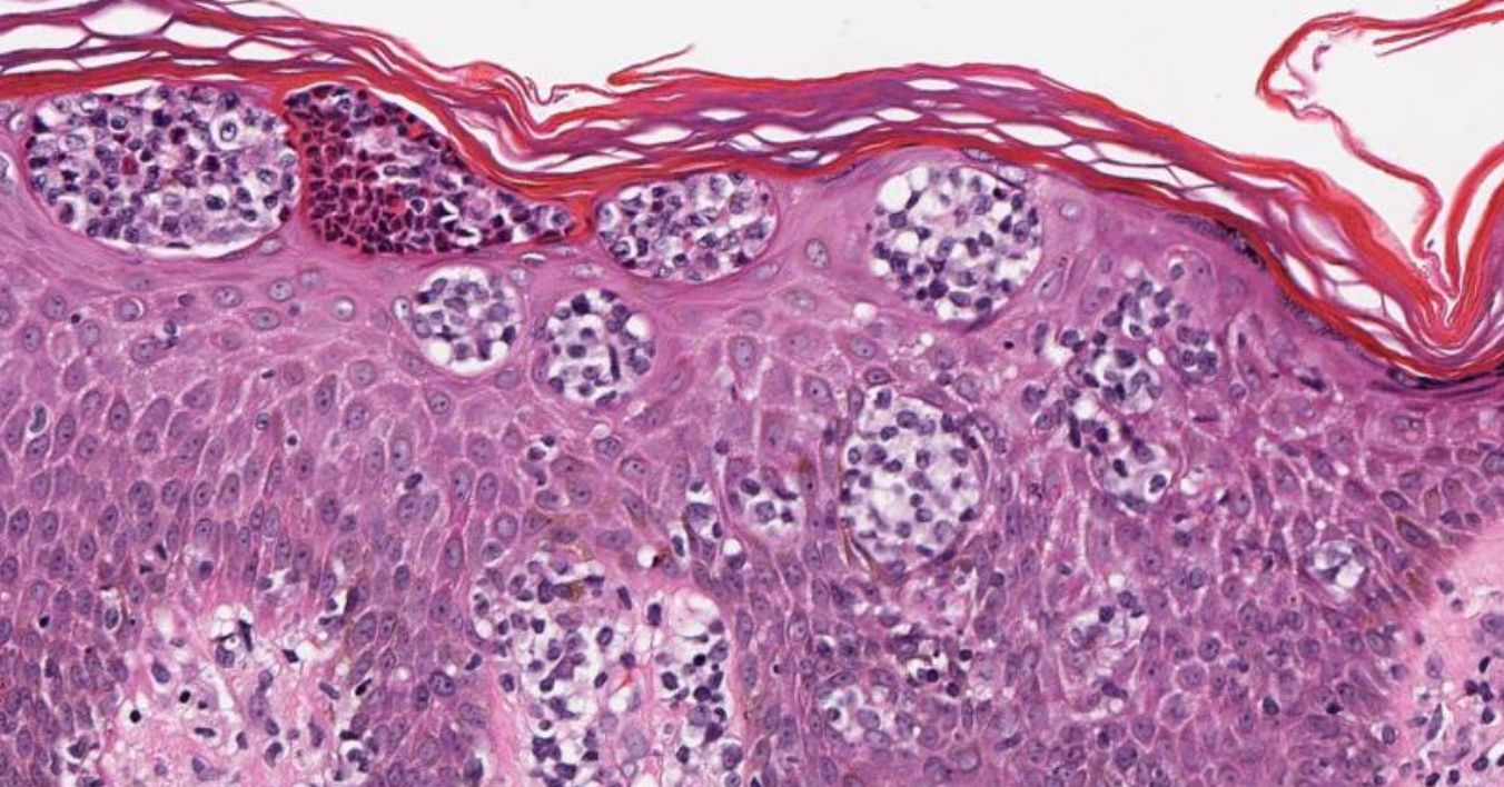 Dermatopathology, Cutaneous Lymphomas Article