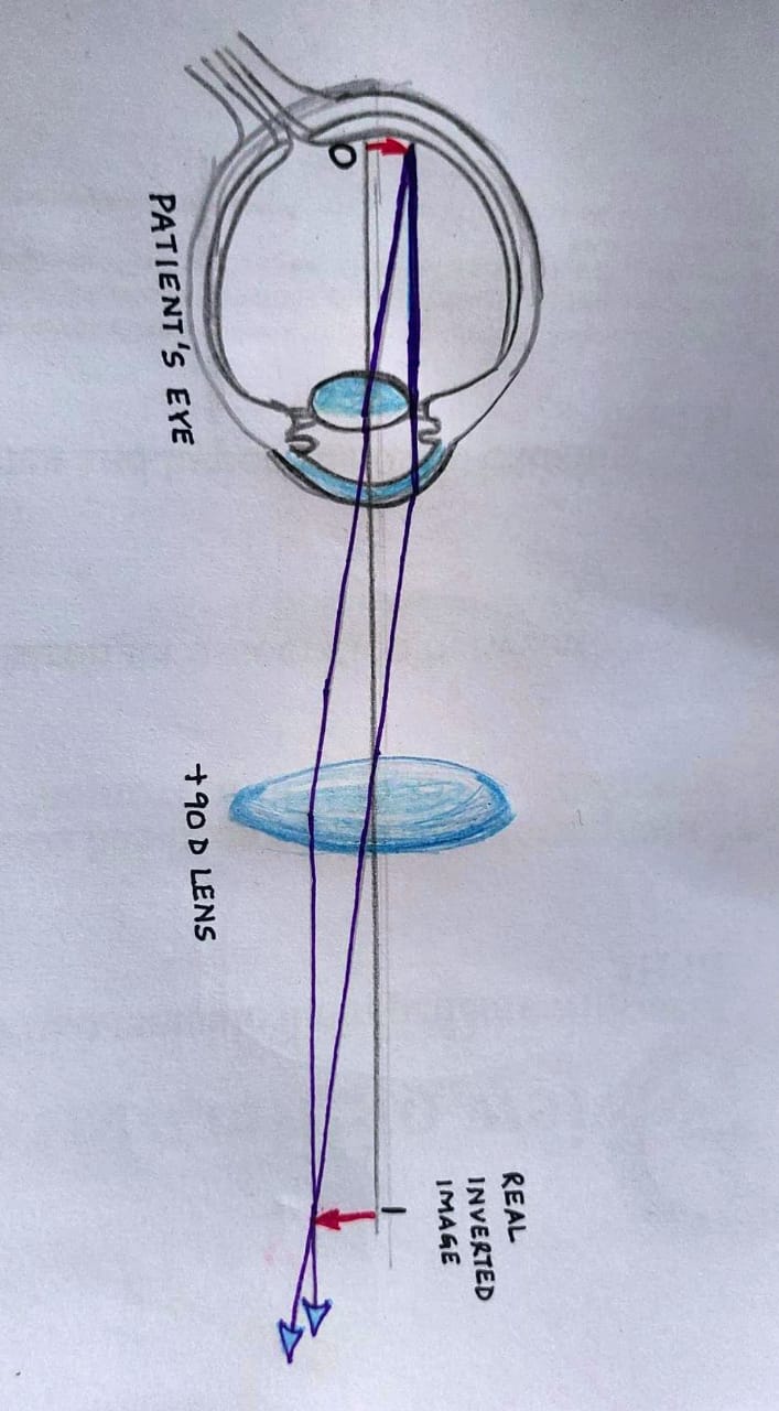 Auxiliary Lenses for Slit-Lamp Examination of the Retina | Treatment ...