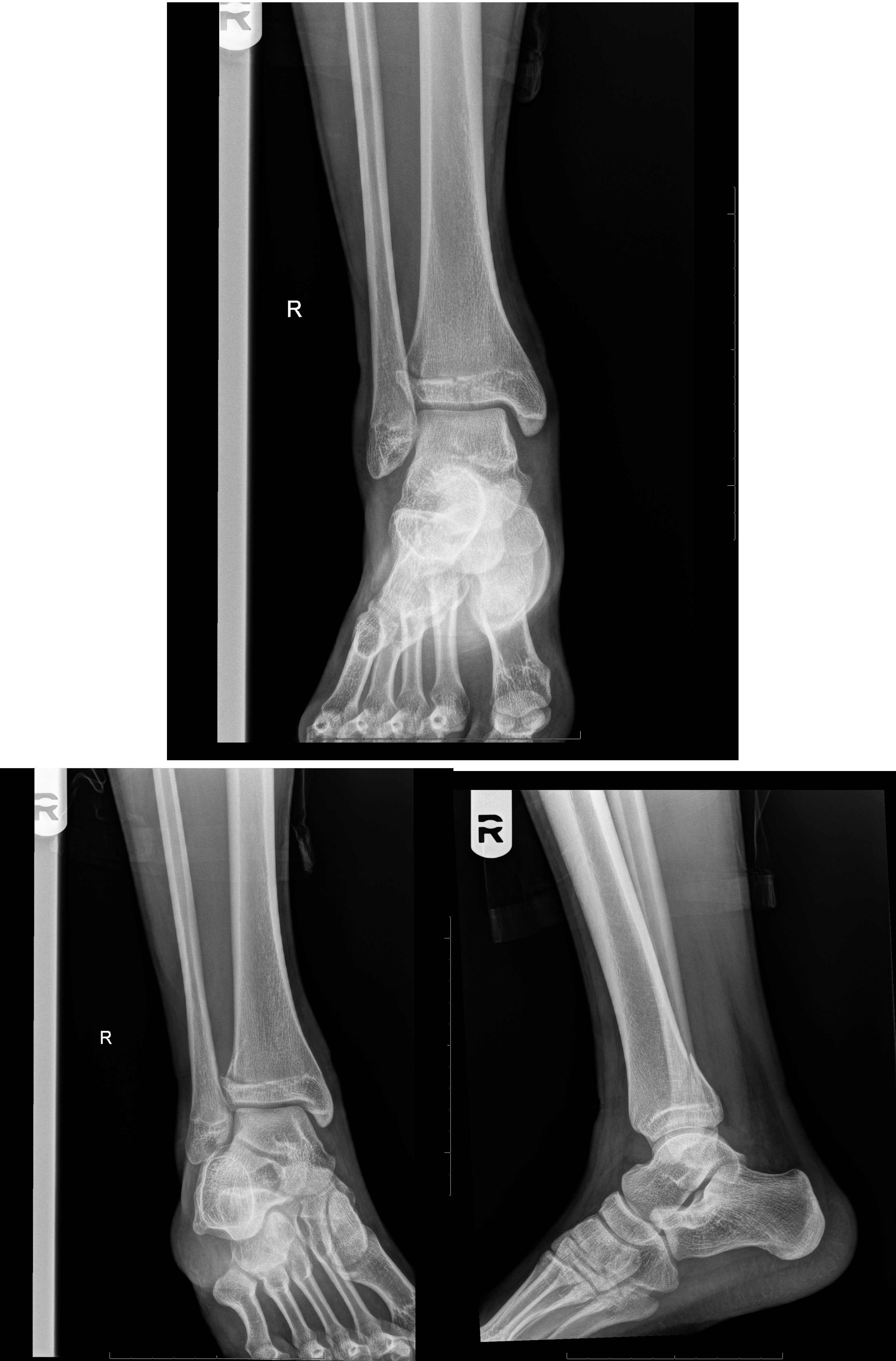 salter-harris-fracture-treatment-management-point-of-care