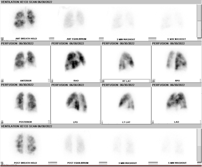 Lung Perfusion Scan Article