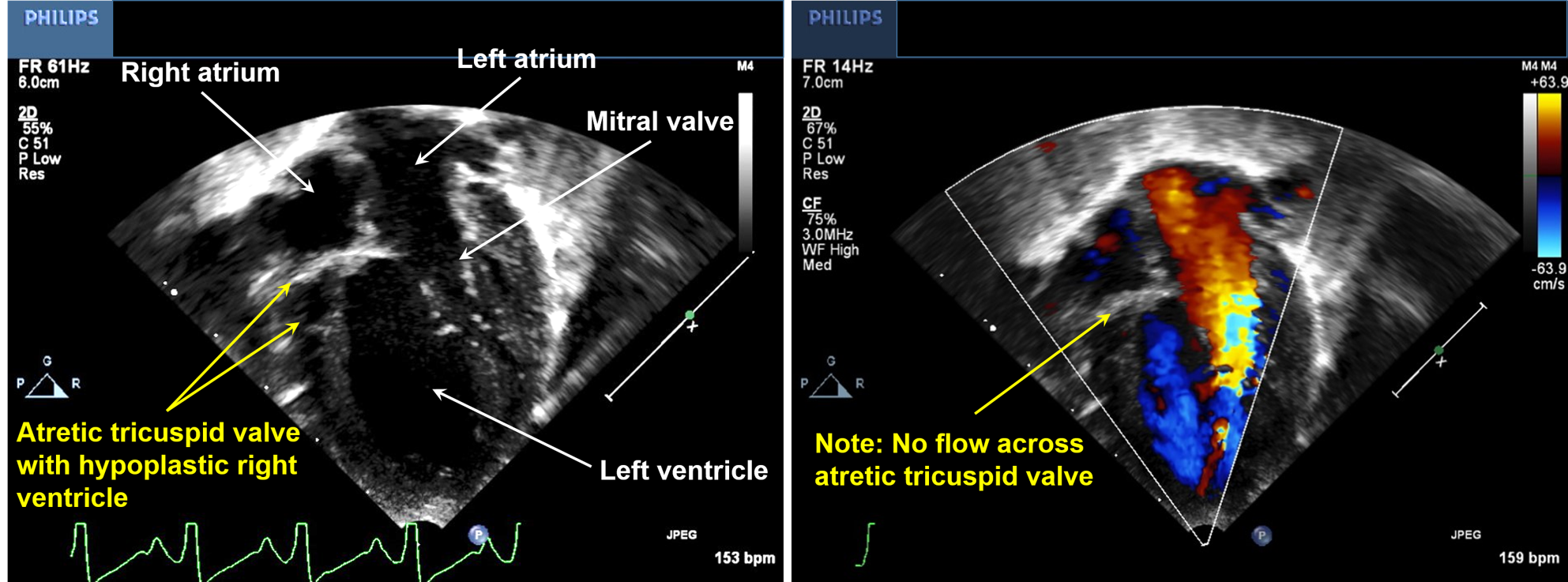 Tricuspid Atresia | Treatment & Management | Point of Care