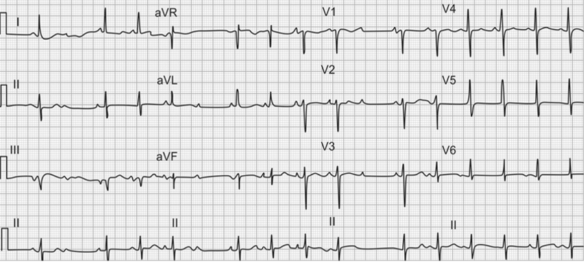 Atrioventricular Block | Treatment & Management | Point of Care