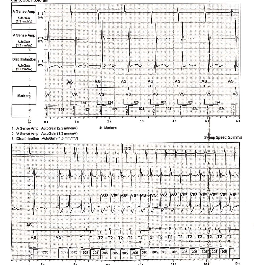 Ambulatory ECG Monitoring | Treatment & Management | Point of Care