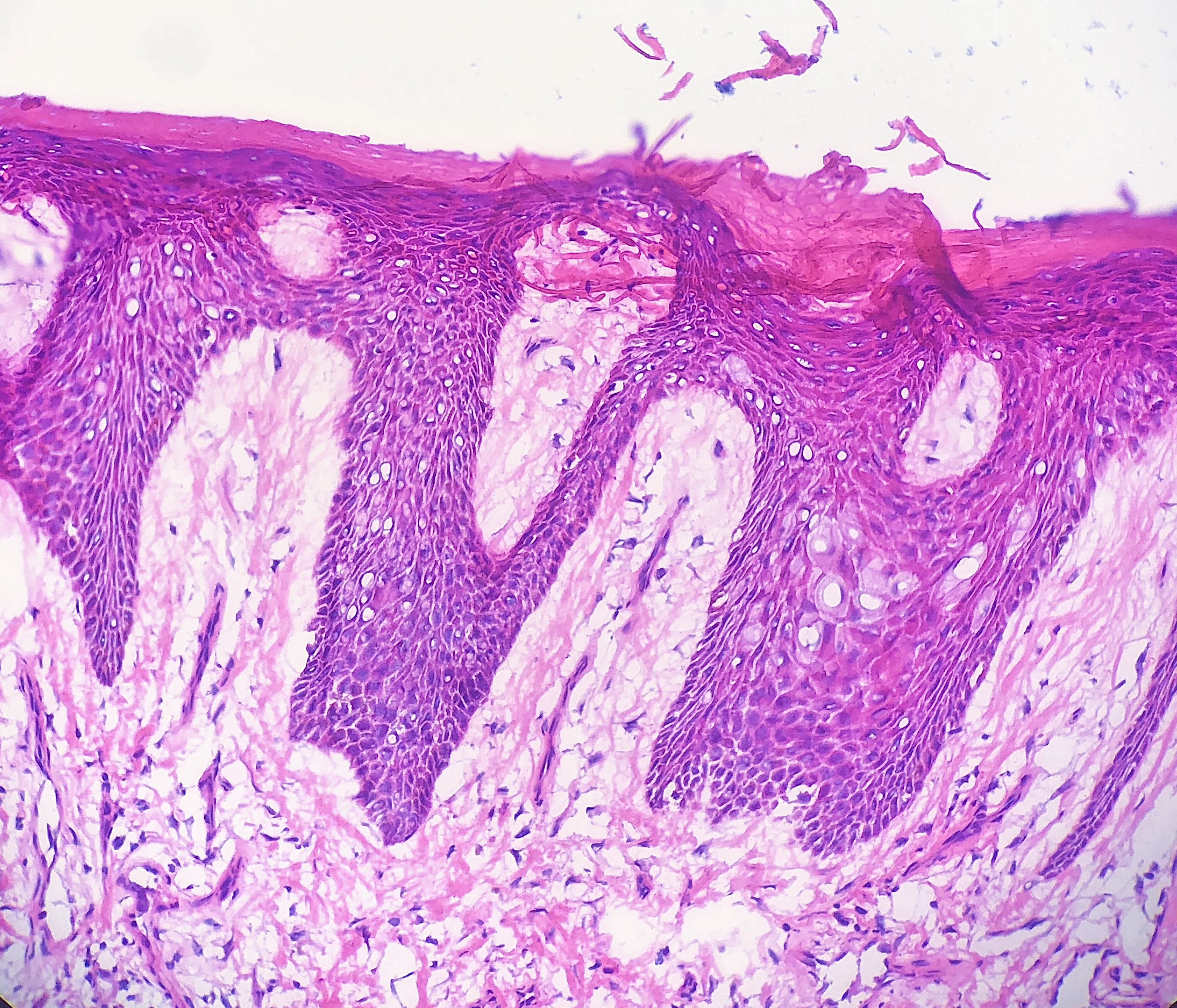 Dermatopathology Histology Artifacts | Treatment & Management | Point ...