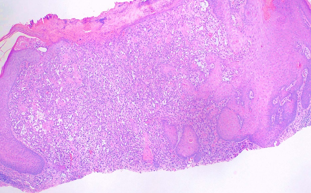 Cutaneous Squamous Cell Carcinoma | Treatment & Management | Point of Care