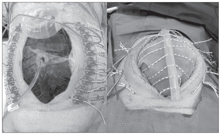 Temporary Abdominal Closure Techniques Treatment And Management Point