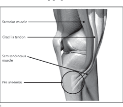 Pes Anserine Bursitis 