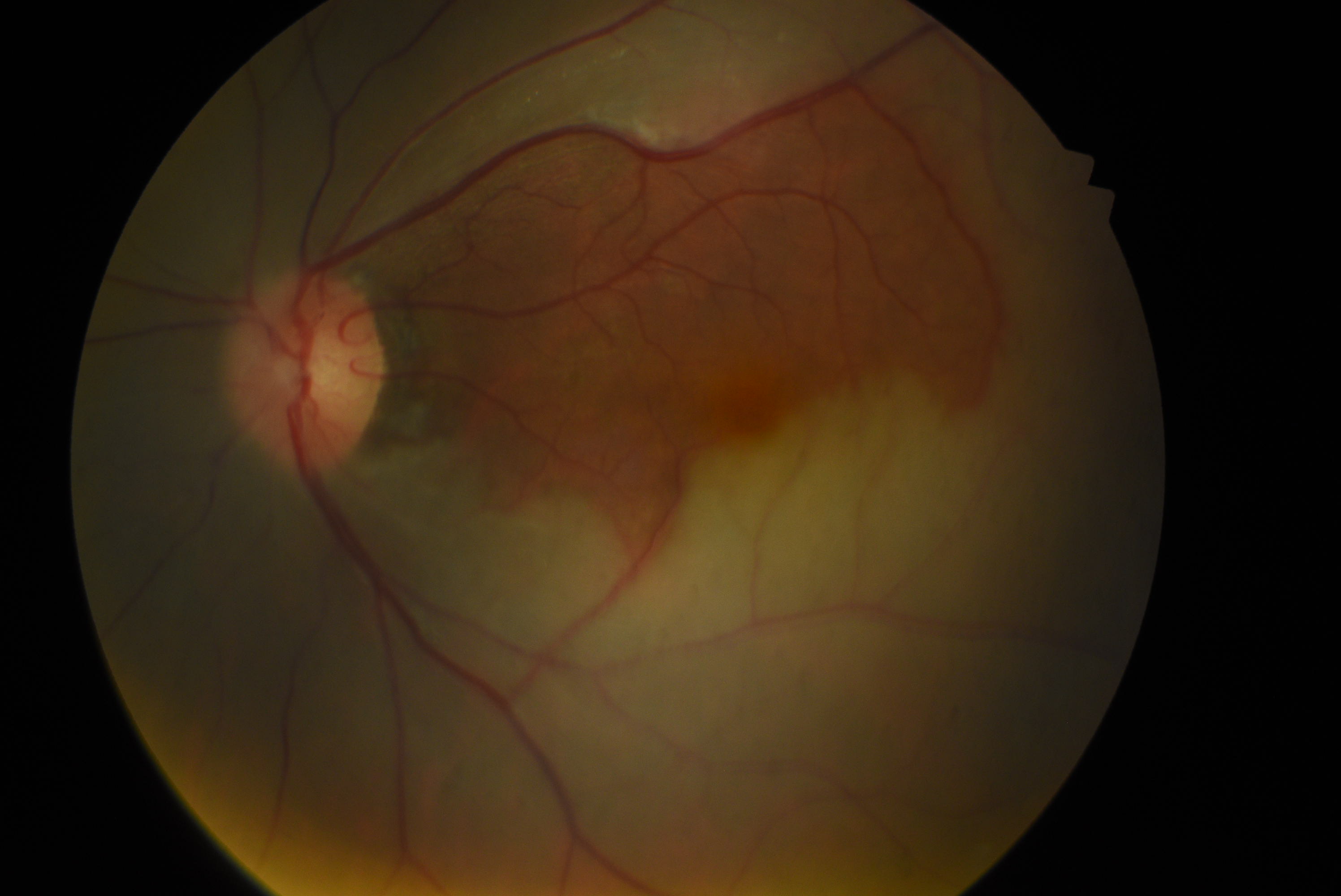 Central Retinal Artery Occlusion | Treatment & Management | Point of Care