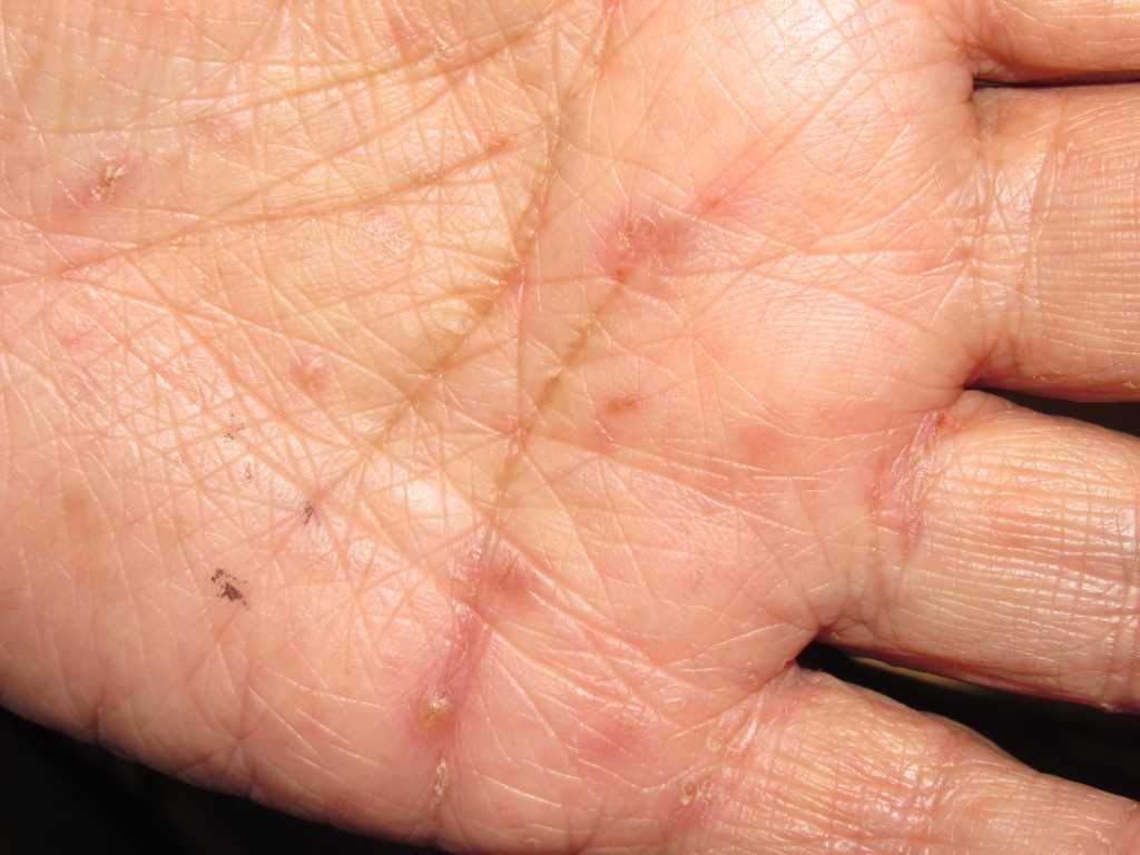 Scabies Signs Symptoms And Complications Vlr Eng Br