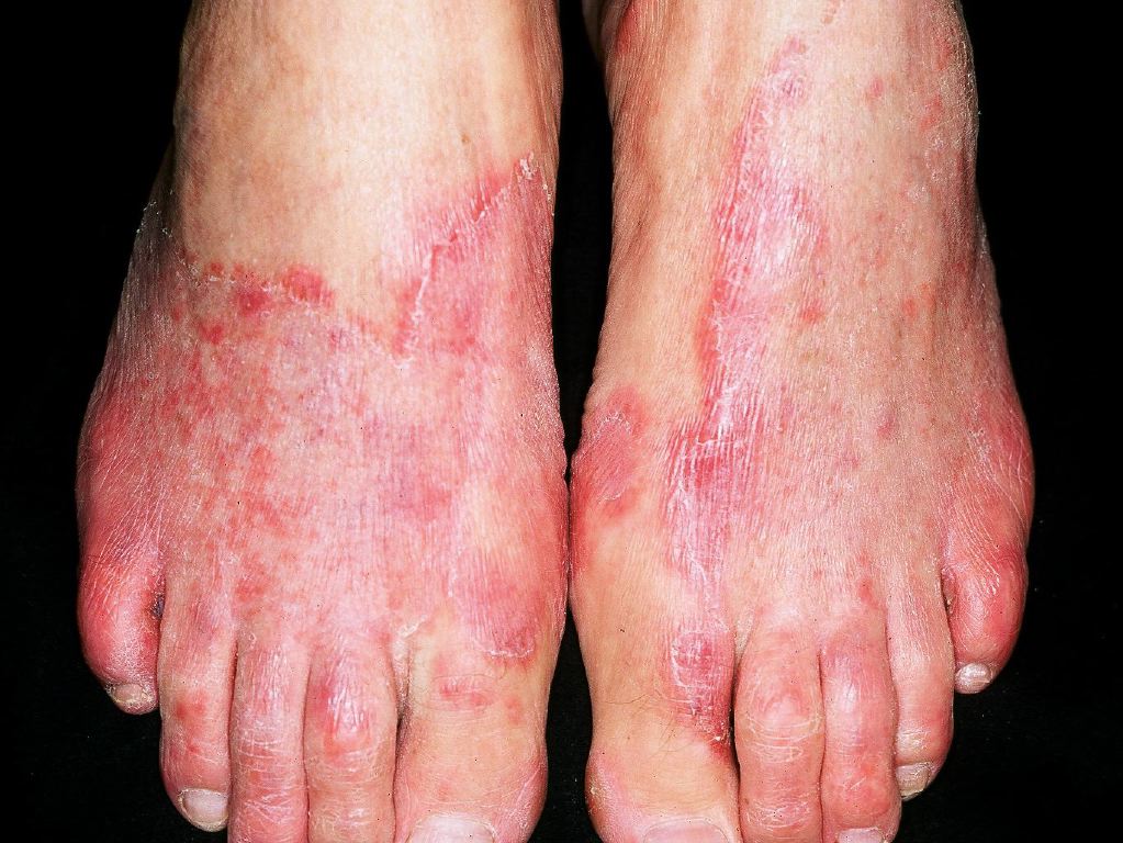 Tinea Pedis (Athlete's Foot) - Dermatologic Disorders - Merck
