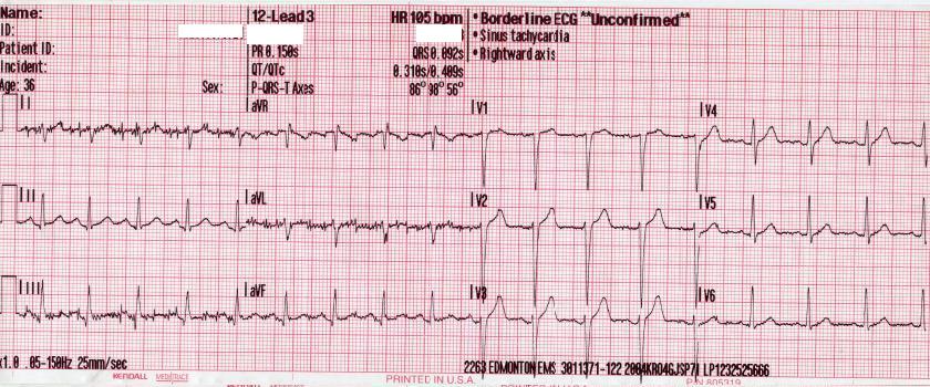 Sinus Tachycardia | Treatment & Management | Point of Care