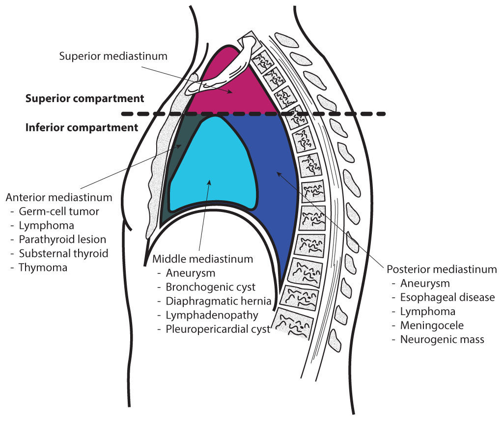 Anatomy, Thorax, Lung Pleura And Mediastinum | Treatment & Management ...