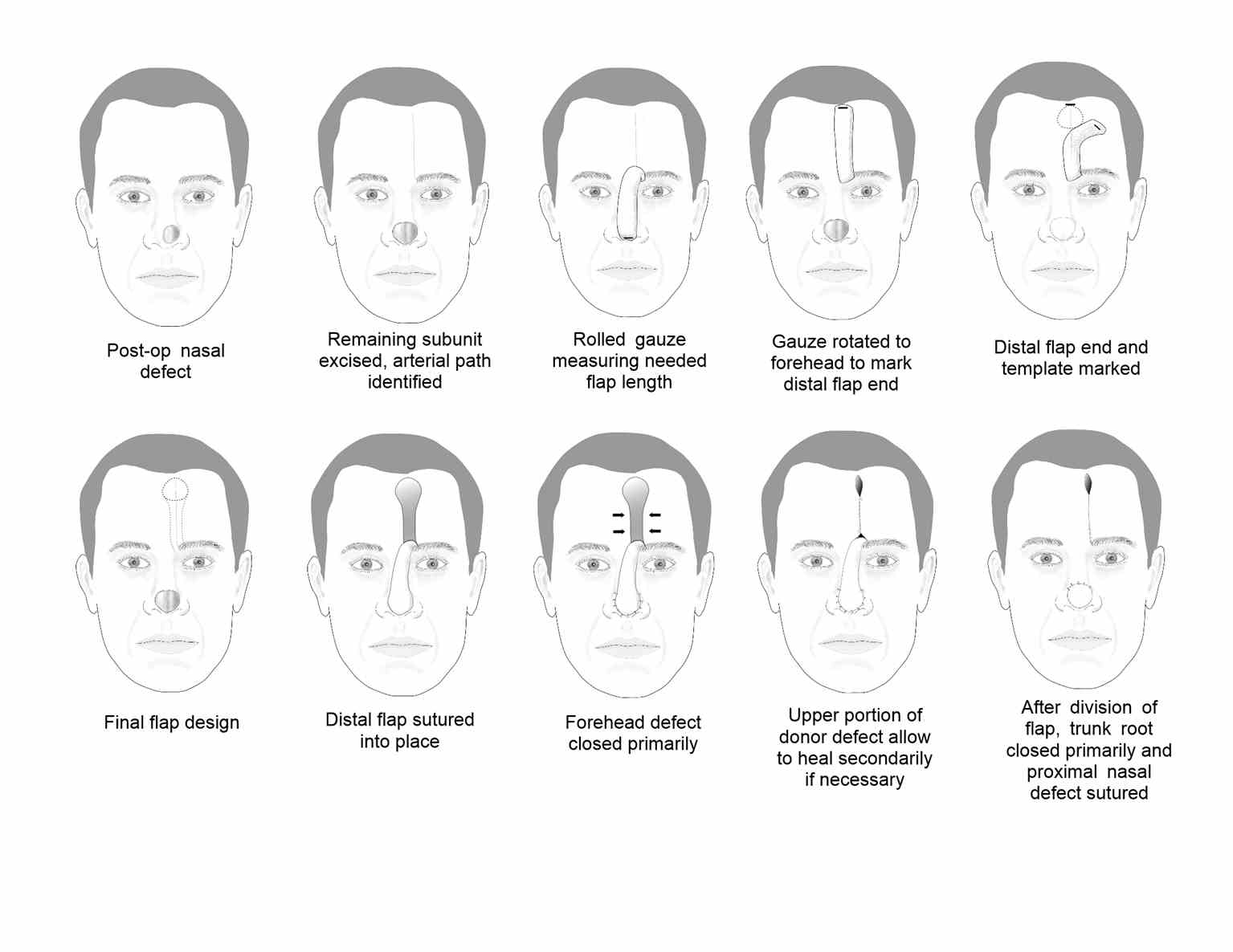 Paramedian Forehead Flaps | Treatment & Management | Point of Care