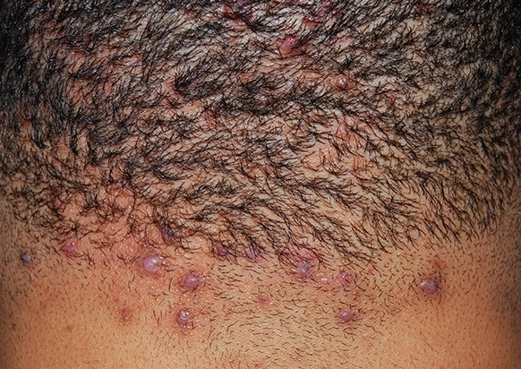 Acne Keloidalis Nuchae Treatment And Management Point Of Care 